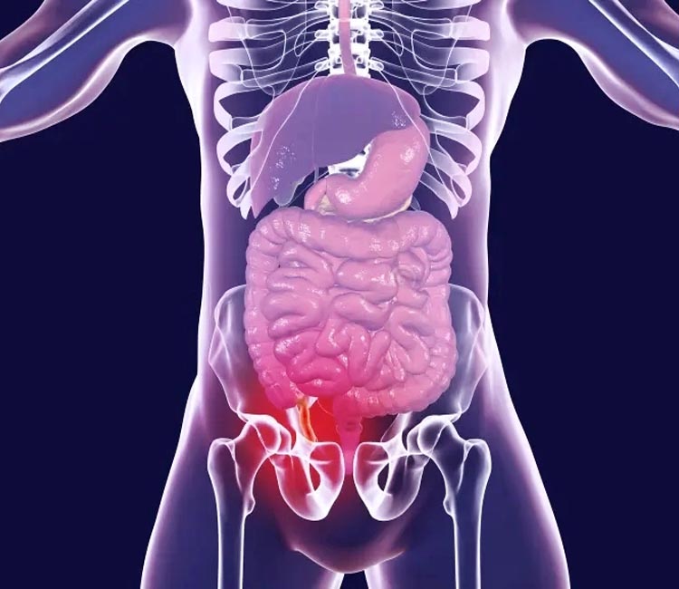 Direct Inguinal Hernia Image
