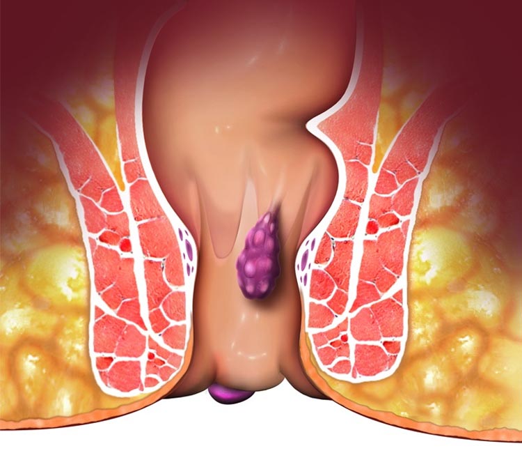 Indirect Inguinal Hernia Image