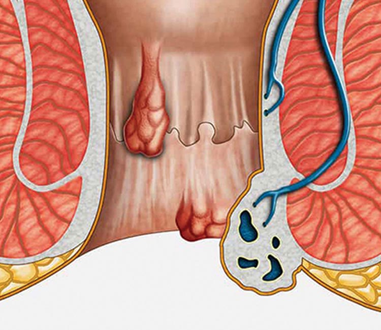 Femoral Hernia Image